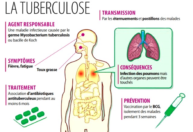 Tuberculose